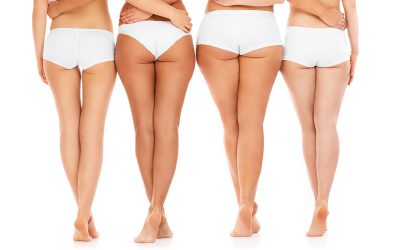 CELULITIS – Adios piel de naranja!