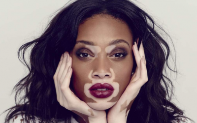 Vitíligo – Qué es?