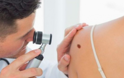 Melanoma – Aprende a detectarlo!