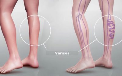 VARICES Y PIERNAS CANSADAS
